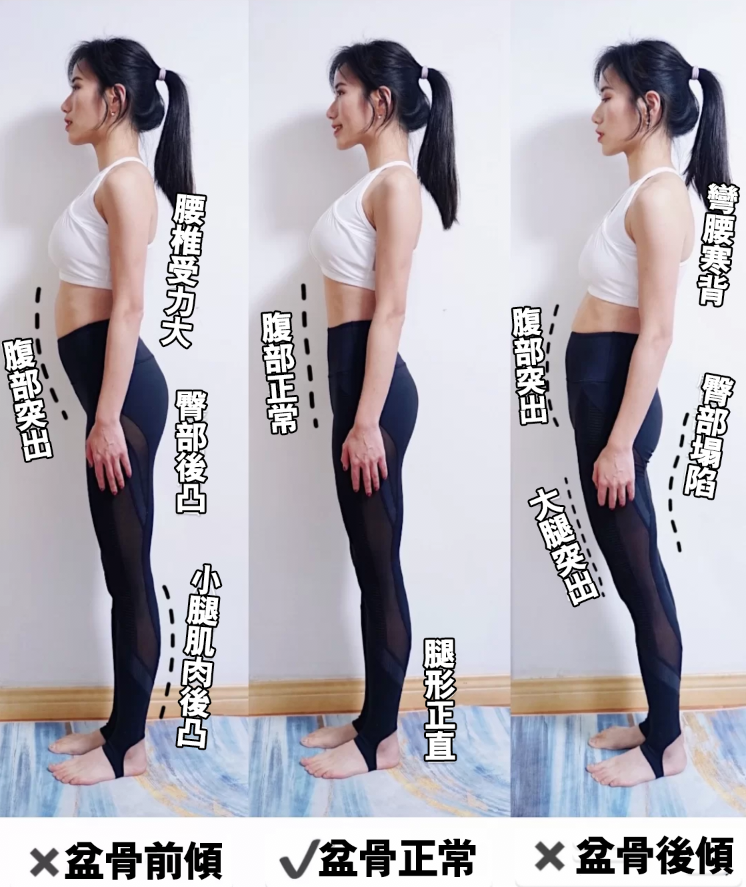骨盆前倾如何矫正(图4)