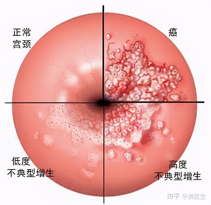 hpv是艾滋病吗_HPV与艾滋病傻傻分不清？(图1)