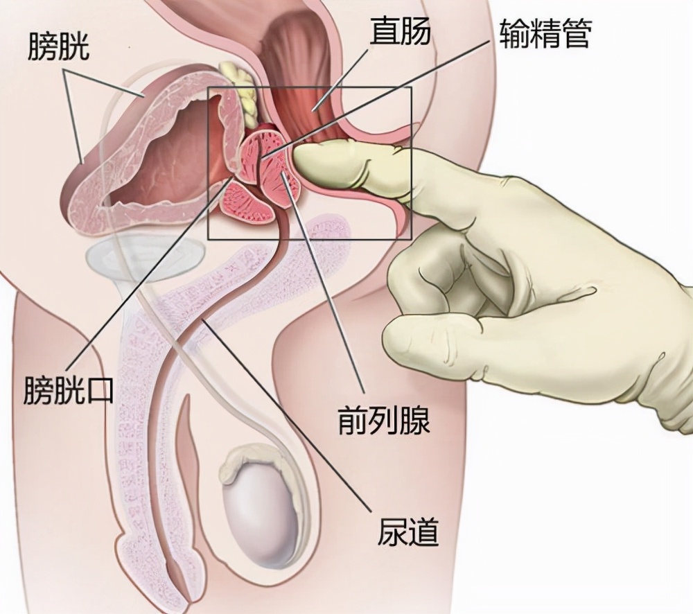 前列腺炎对生育有影响吗(图2)