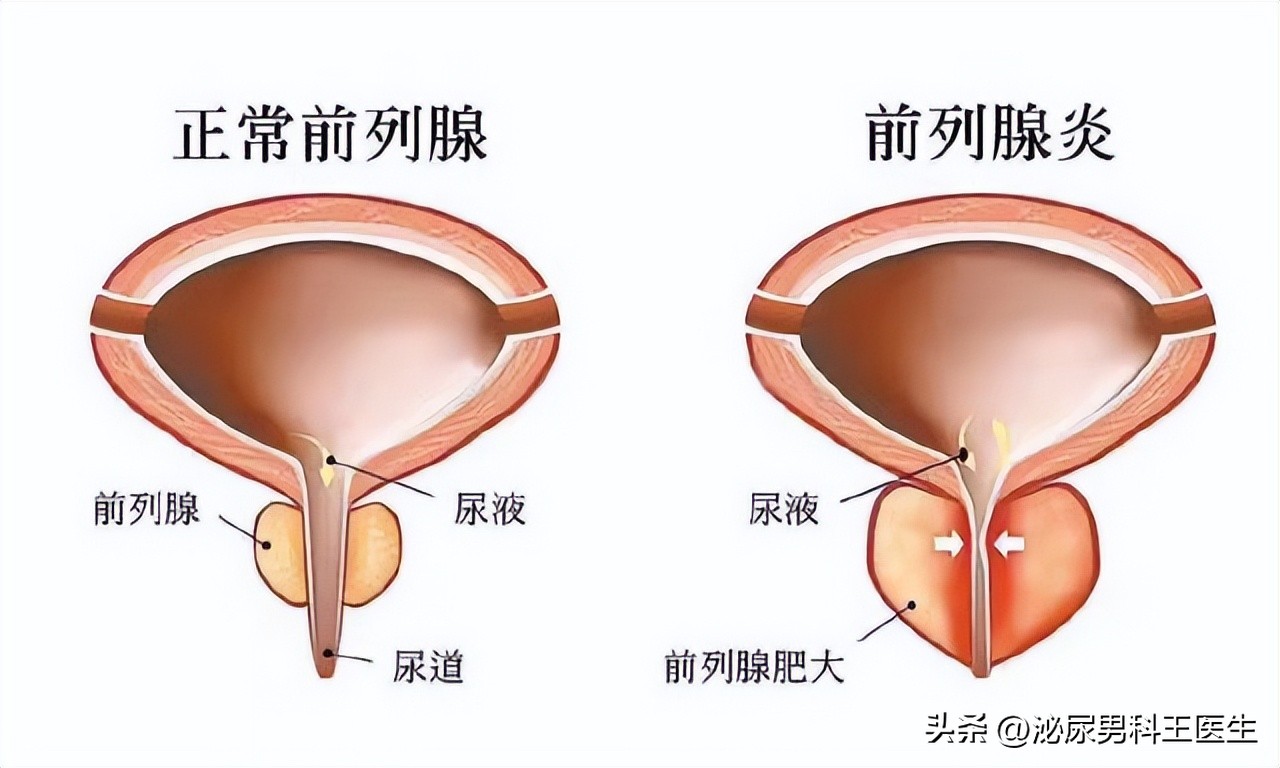 前列腺炎对生育有影响吗(图4)