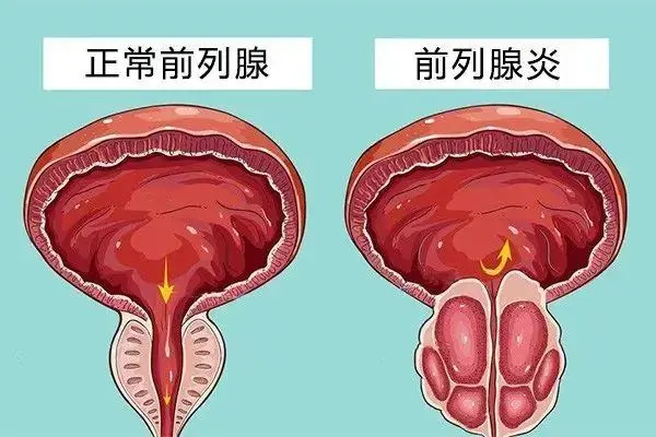 前列腺炎对生育有影响吗(图6)