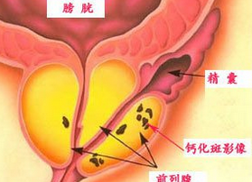 前列腺炎对生育有影响吗(图3)