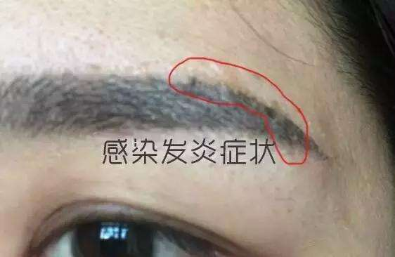 纹眉对身体有多大的伤害_纹眉美丽背后的潜在风险(图9)