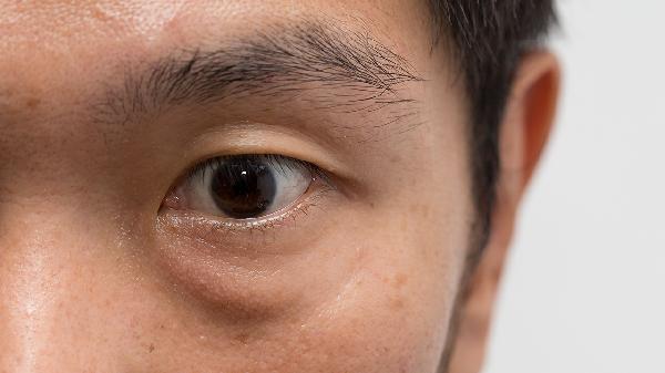 天生眼袋重是什么原因造成的(图1)