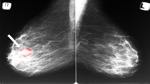 胃部肿瘤全切两年后为什么越来越瘦(图1) 胃部肿瘤全切两年后为什么越来越瘦(图1)