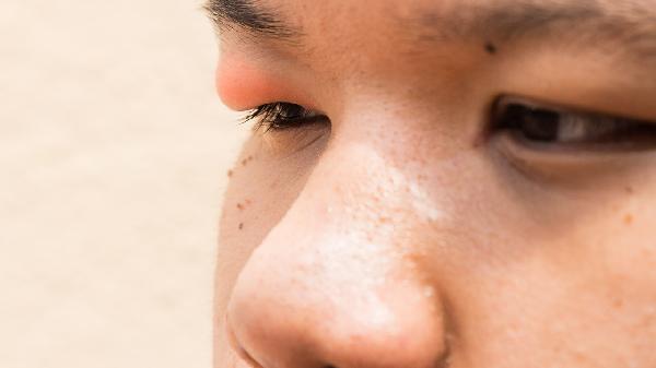 痛性眼睛麻痹综合征治疗(图1) 痛性眼睛麻痹综合征治疗(图1)