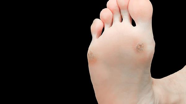 脚上水泡瘙痒？揭秘3大元凶与快速缓解妙招(图2)