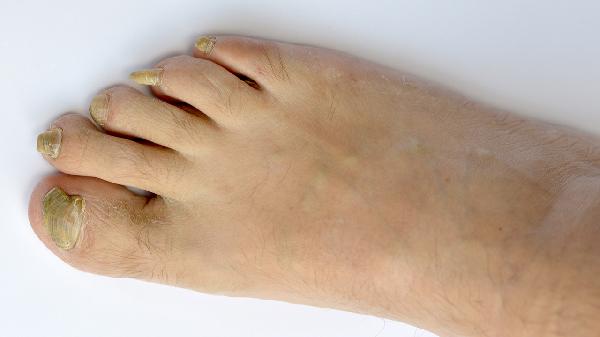 脚趾指甲盖不知道怎么了(图2)