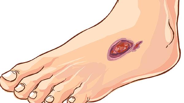 了解脓头：脓疱的外观特征及预防护理方法(图1)