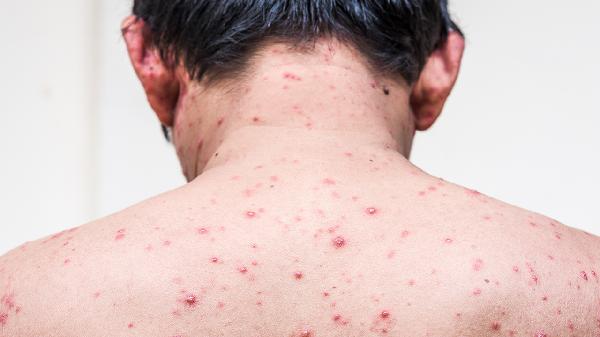 脖子上突然起来一些红肿的包(图2)