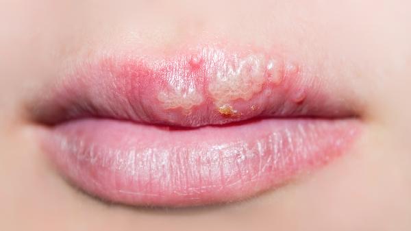 女性大腿内侧疱疹的原因是什么？(图1)
