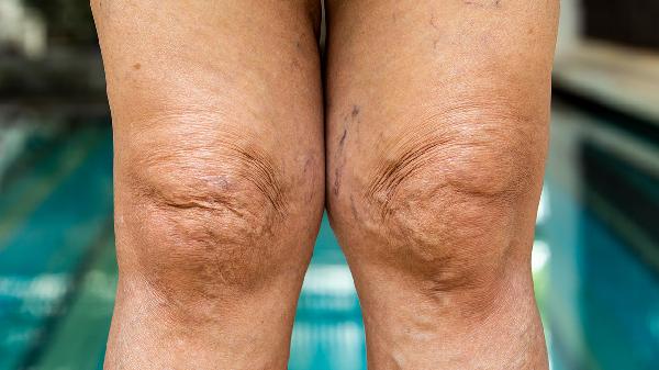 睡前喝水第二天脸会水肿吗(图2) 睡前喝水第二天脸会水肿吗(图2)