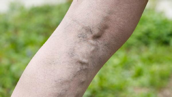 睡前喝水第二天脸会水肿吗(图1) 睡前喝水第二天脸会水肿吗(图1)