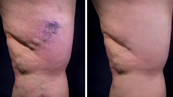 淋巴性水肿可采取哪些治疗方法(图2) 淋巴性水肿可采取哪些治疗方法(图2)