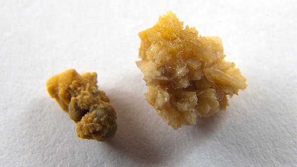 尿酸值降至正常多久能溶石(图1)