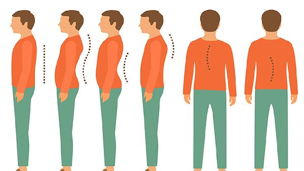 强直性脊柱炎治疗全攻略：从药物到手术，哪种适合你？(图2)