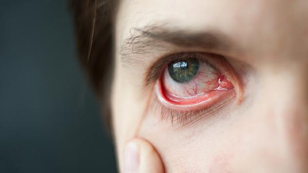 强直性脊柱炎患者必知：如何预防虹膜炎并发症的发生？(图1)