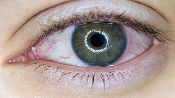 眼睛、突然看不清东西半小时候又恢复正常(图2)