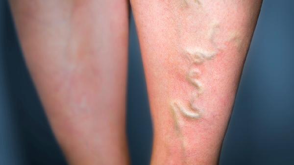 脚腕上方浮肿怎么回事(图2) 脚腕上方浮肿怎么回事(图2)