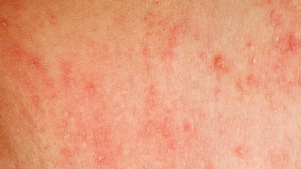 手上长的汗疱疹怎么办(图2) 手上长的汗疱疹怎么办(图2)