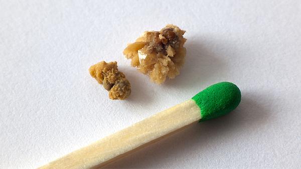 肾盂输尿管结合部结石(图2)