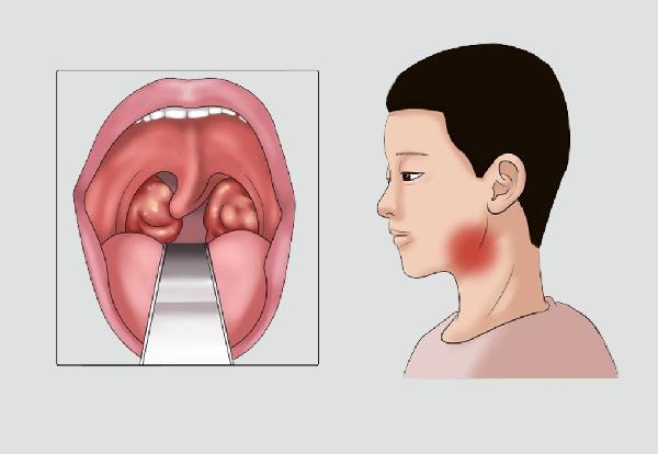 扁桃体发炎怎样才能消下去嗓子疼咳黄痰(图2)