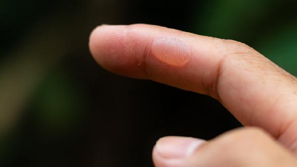 肺起水泡怎么治疗(图1)