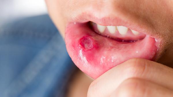溃疡性口炎不能吃什么食物(图2)
