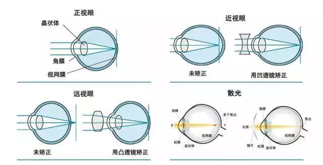 近视眼怎么慢慢恢复视力(图3)