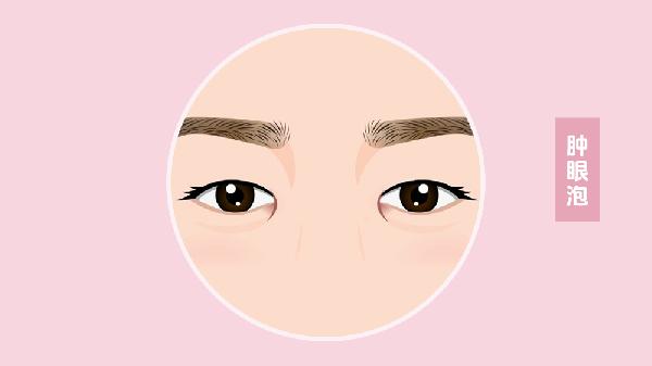 做抽脂消除肿眼泡的步骤及注意事项(图1)