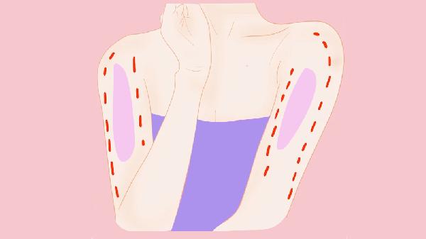 做溶脂瘦手臂手术麻醉方式是什么?(图3) 做溶脂瘦手臂手术麻醉方式是什么?(图3)