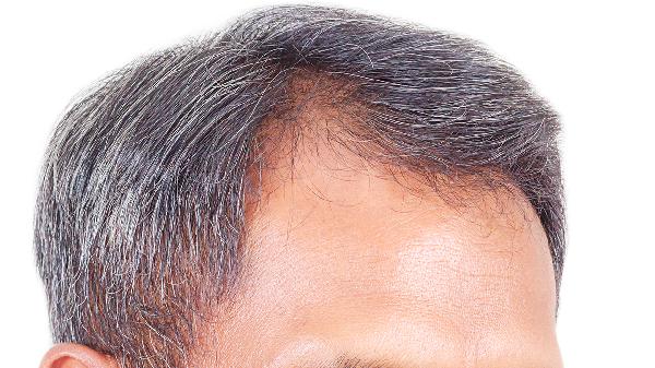 白头发缺少什么维生素.需要吃什么(图1)