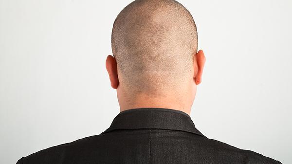 男性脱发严重是什么原因引起的(图2)