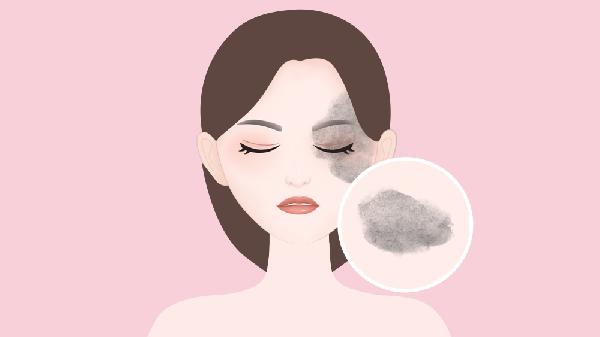 去太田痣失败修复做完要多久时间？(图2)