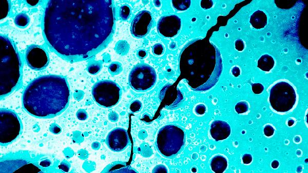 hiv急性期呼吸道感染症状(图2)
