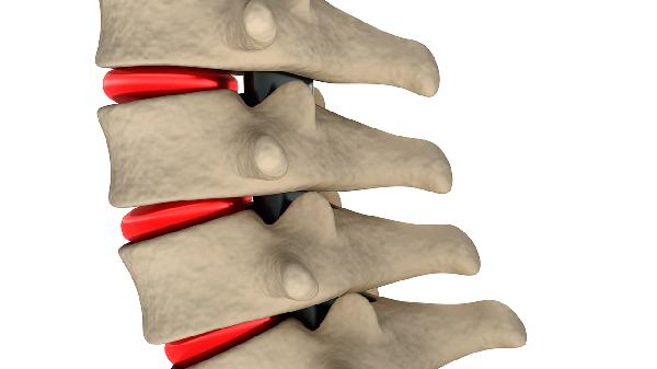 颈椎骨质增生手脚麻木严重吗(图2)