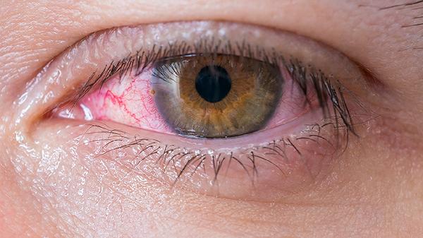 睡前喝水会导致眼睛浮肿吗(图1)