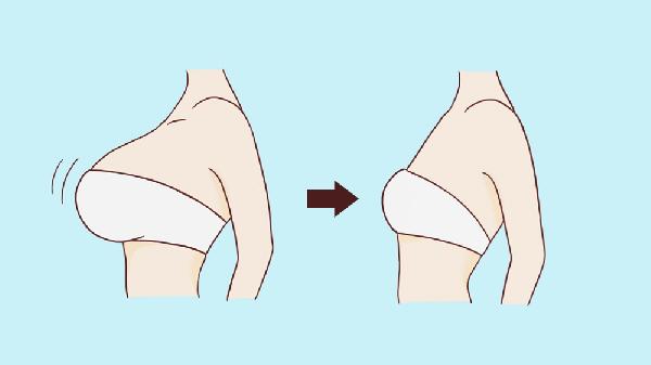 做巨乳缩小失败修复手术多少钱？(图3)