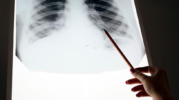 肿瘤坏死因子抑制剂伤口愈合(图1)