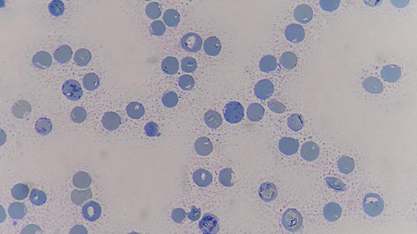 甲状腺4a恶性算不算癌症(图1)