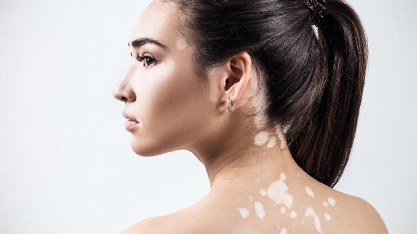 身上皮肤出现白斑怎么回事?(图2)