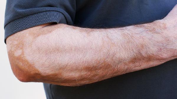 身上皮肤出现白斑怎么回事?(图1)