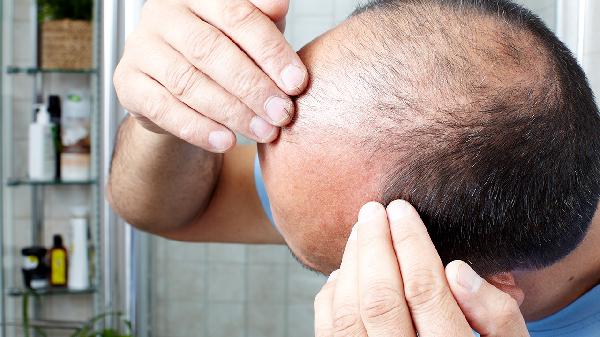 男士脱发是什么原因引起的(图2)