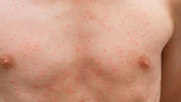 身上皮肤有白点是什么原因(图1) 身上皮肤有白点是什么原因(图1)