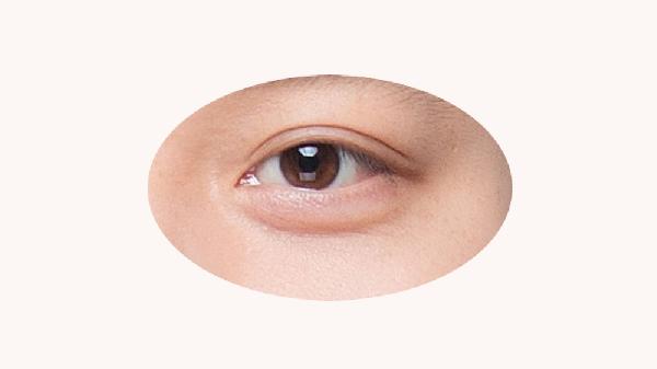 无锡做双眼皮手术的费用是多少钱啊(图3)