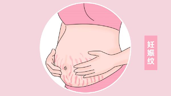 做去妊娠纹术前要做什么准备(图1)