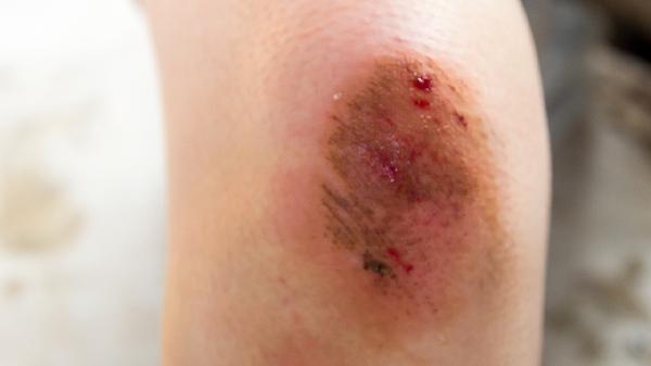 三氯异氰尿酸对人体的危害(图2)