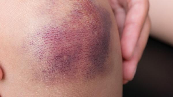 肛周脓肿手术后伤口多久才能愈合好(图1)