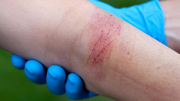 肛周脓肿手术后伤口多久才能愈合好(图3)