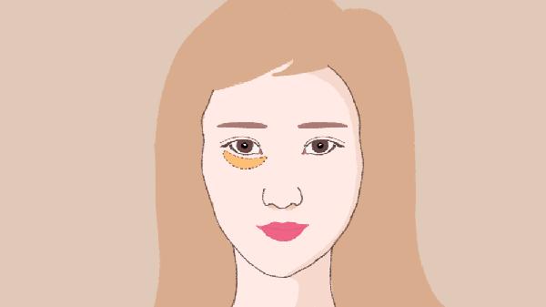 胶原蛋白填充泪沟手术的方法是什么？(图3)